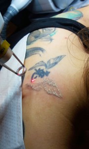 laserowe-usuwanie-tatuażu---zabieg
